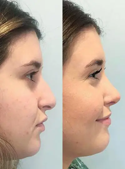 Before and after