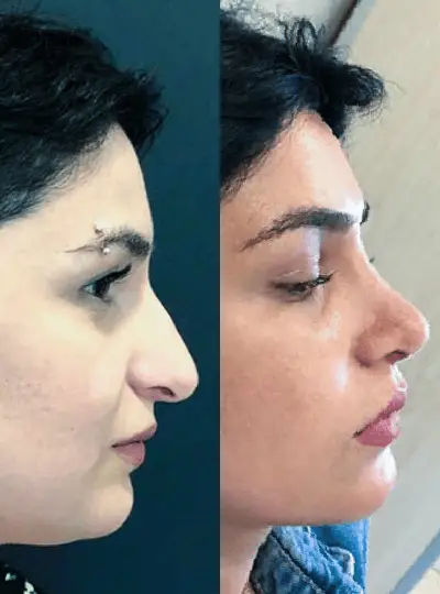 Before and after