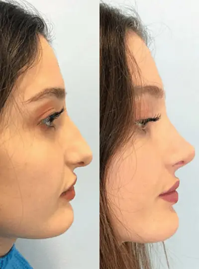 Before and after